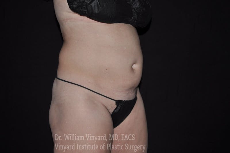Tummy Tuck Before & After Gallery - Patient 169942782 - Image 9