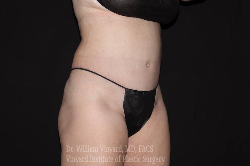 Tummy Tuck Before & After Gallery - Patient 169942782 - Image 10