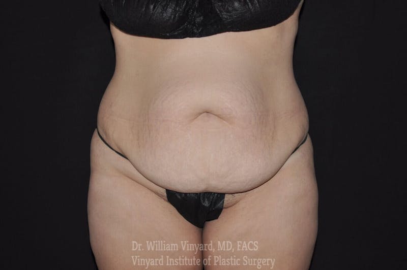 Tummy Tuck Before & After Gallery - Patient 169942784 - Image 1