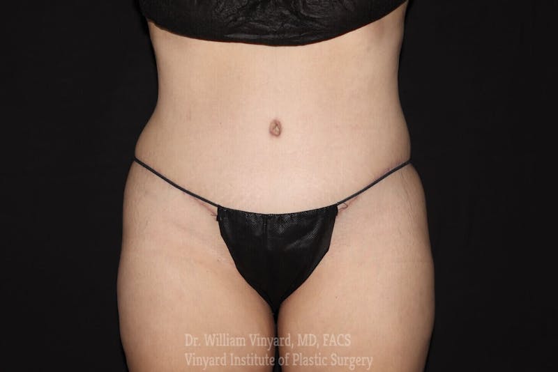 Tummy Tuck Before & After Gallery - Patient 169942784 - Image 2