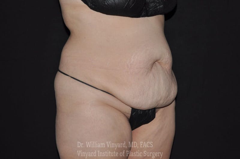 Tummy Tuck Before & After Gallery - Patient 169942784 - Image 3