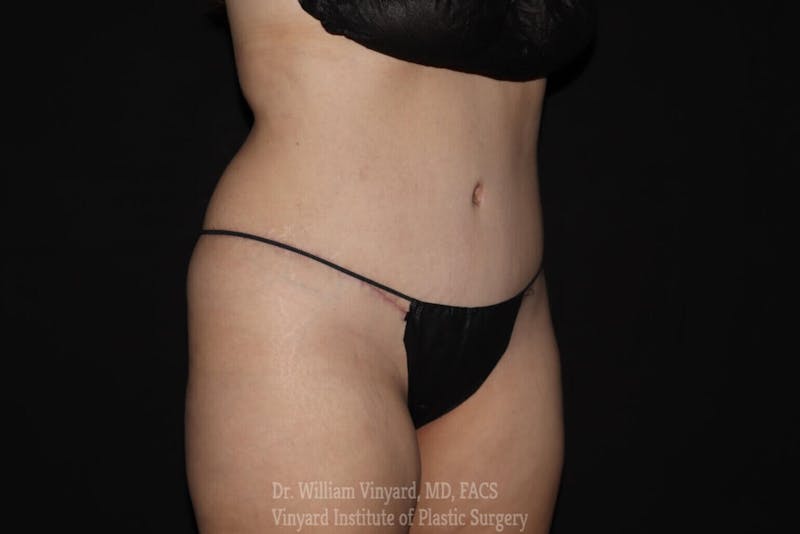 Tummy Tuck Before & After Gallery - Patient 169942784 - Image 4