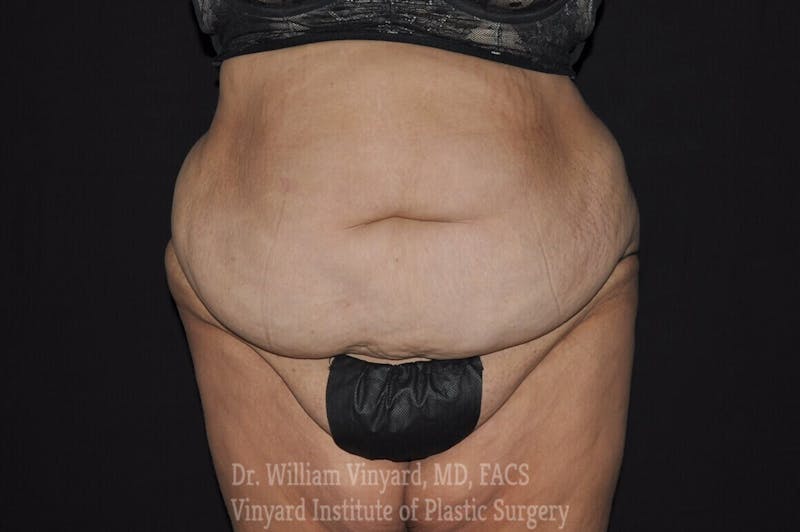 Tummy Tuck Before & After Gallery - Patient 169942787 - Image 1
