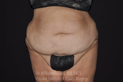Tummy Tuck Before & After Gallery - Patient 169942787 - Image 1