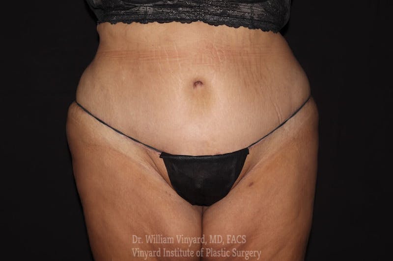 Tummy Tuck Before & After Gallery - Patient 169942787 - Image 2