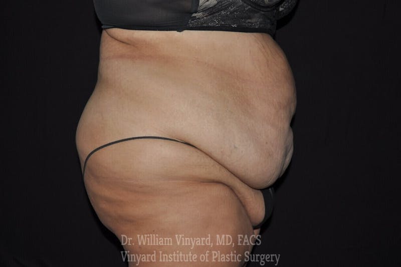 Tummy Tuck Before & After Gallery - Patient 169942787 - Image 3