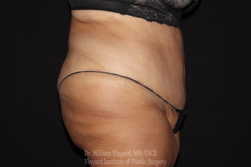 Tummy Tuck Before & After Gallery - Patient 169942787 - Image 4