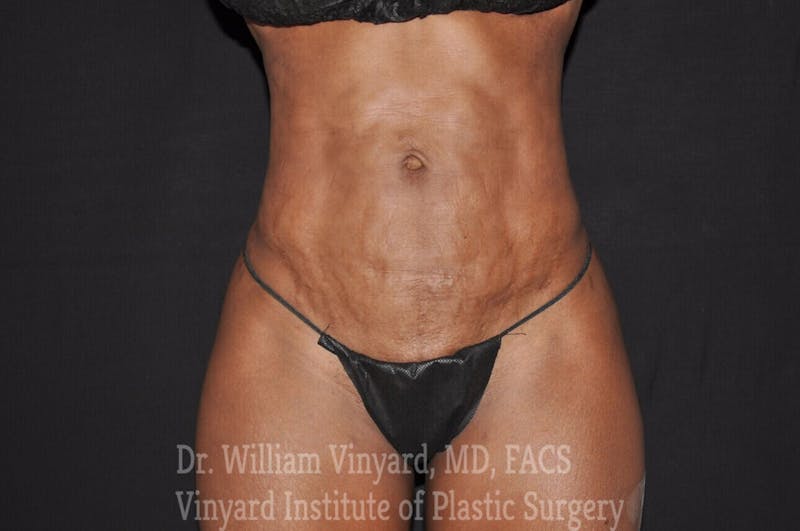 Tummy Tuck Before & After Gallery - Patient 169942788 - Image 1