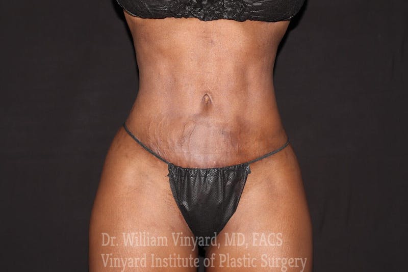 Tummy Tuck Before & After Gallery - Patient 169942788 - Image 2