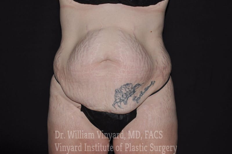 Tummy Tuck Before & After Gallery - Patient 169942790 - Image 1