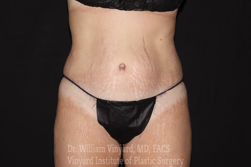 Tummy Tuck Before & After Gallery - Patient 169942790 - Image 2