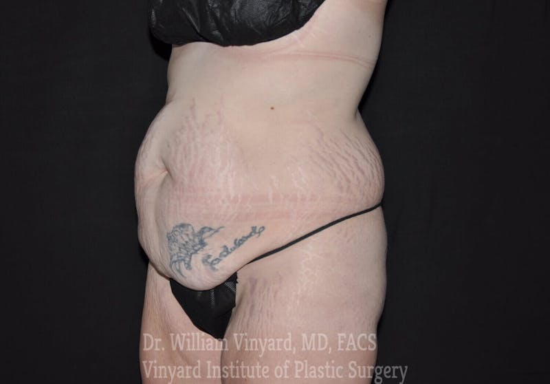 Tummy Tuck Before & After Gallery - Patient 169942790 - Image 3