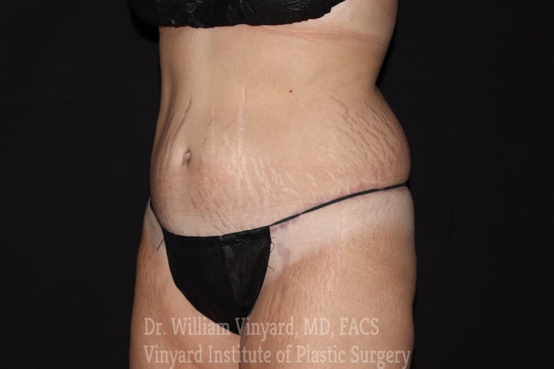Tummy Tuck Before & After Gallery - Patient 169942790 - Image 4
