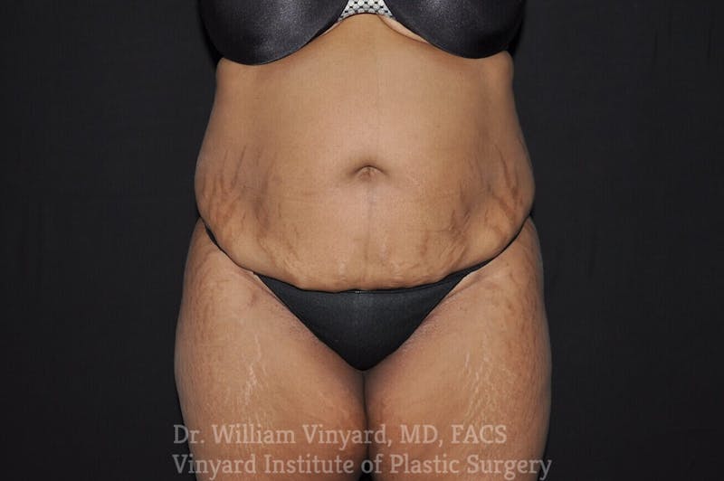 Tummy Tuck Before & After Gallery - Patient 169942791 - Image 1