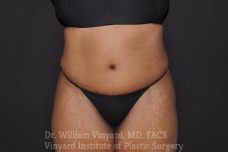Tummy Tuck Before & After Gallery - Patient 169942791 - Image 2