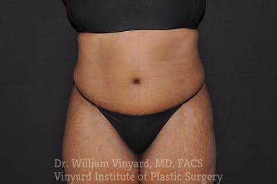 Tummy Tuck Before & After Gallery - Patient 169942791 - Image 2