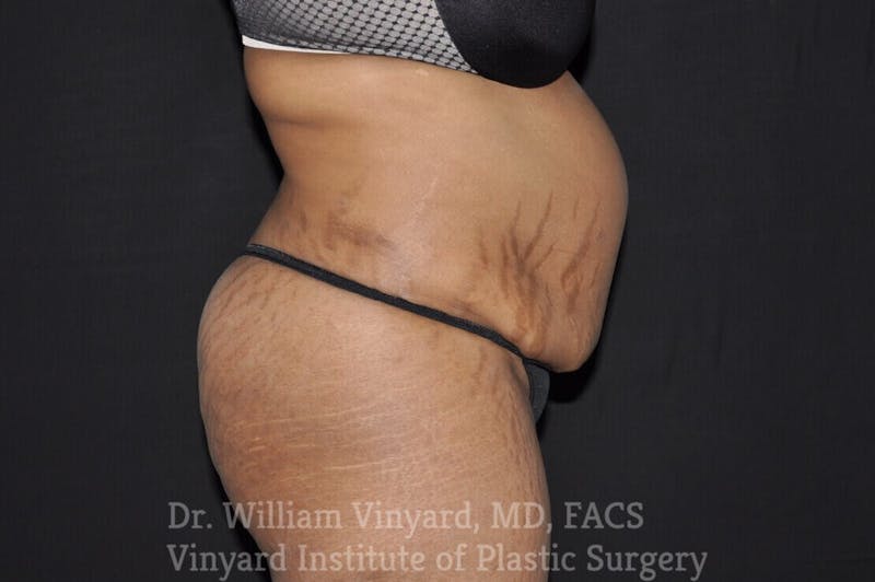 Tummy Tuck Before & After Gallery - Patient 169942791 - Image 3