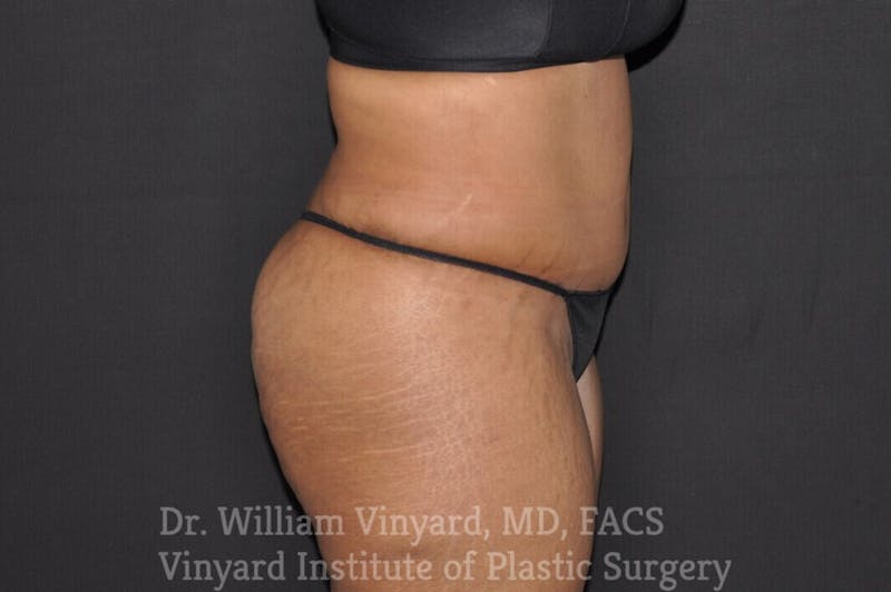 Tummy Tuck Before & After Gallery - Patient 169942791 - Image 4