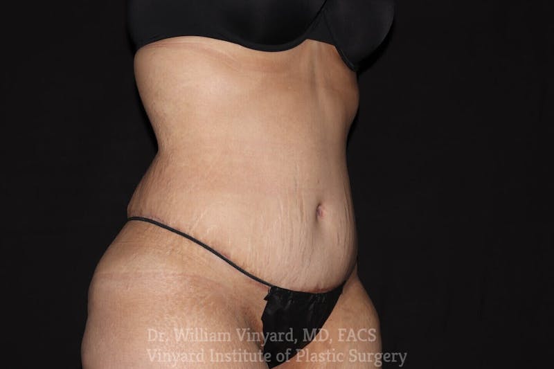 Tummy Tuck Before & After Gallery - Patient 169942792 - Image 2