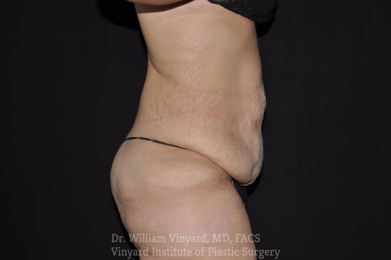 Tummy Tuck Before & After Gallery - Patient 169942792 - Image 3