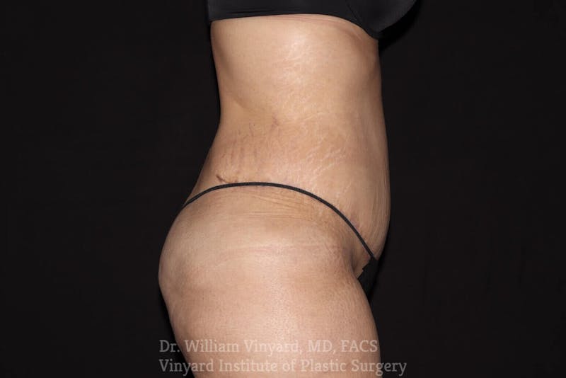 Tummy Tuck Before & After Gallery - Patient 169942792 - Image 4