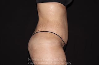 Tummy Tuck Before & After Gallery - Patient 169942792 - Image 4