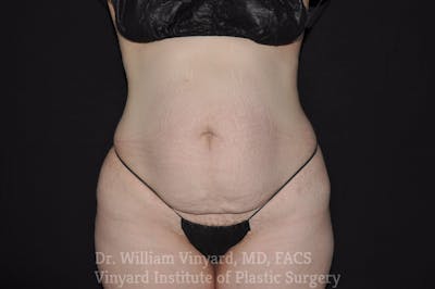 Tummy Tuck Before & After Gallery - Patient 169942793 - Image 1