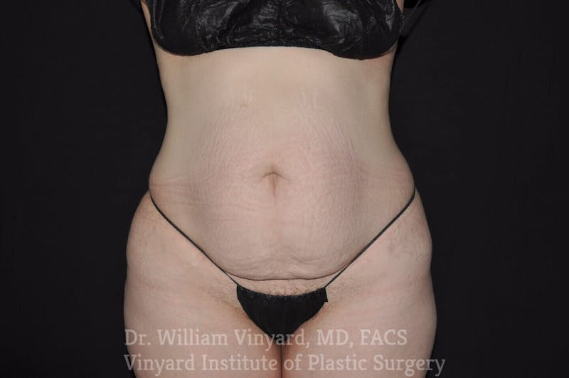 Tummy Tuck Before & After Gallery - Patient 169942793 - Image 1