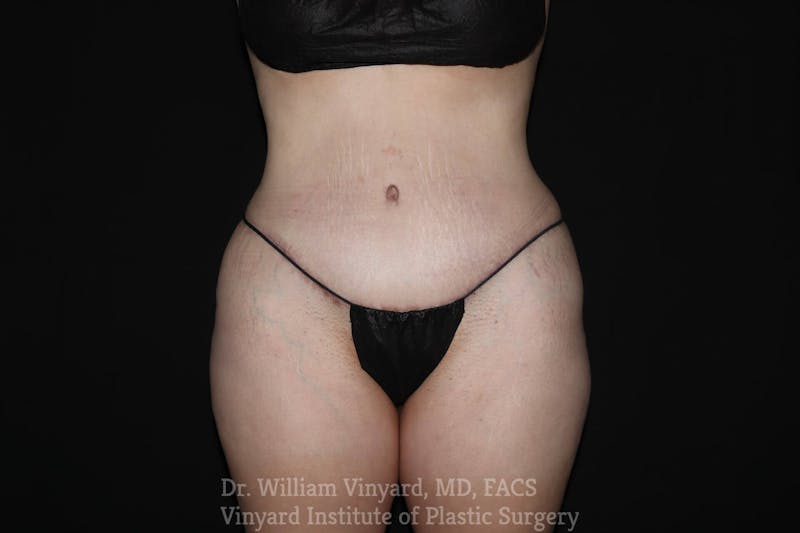 Tummy Tuck Before & After Gallery - Patient 169942793 - Image 2