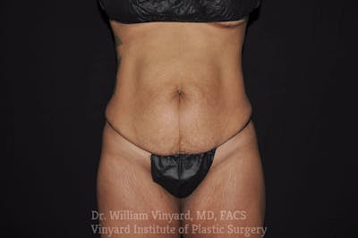 Tummy Tuck Before & After Gallery - Patient 169942795 - Image 1