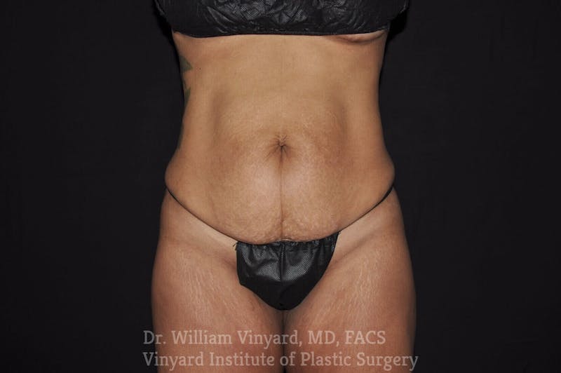 Tummy Tuck Before & After Gallery - Patient 169942795 - Image 1