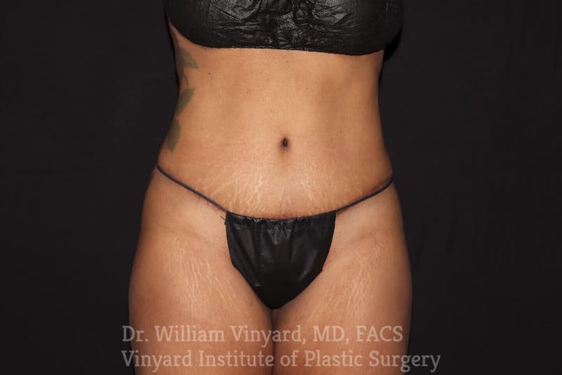 Tummy Tuck Before & After Gallery - Patient 169942795 - Image 2