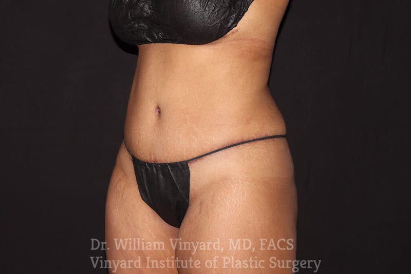 Tummy Tuck Before & After Gallery - Patient 169942795 - Image 4