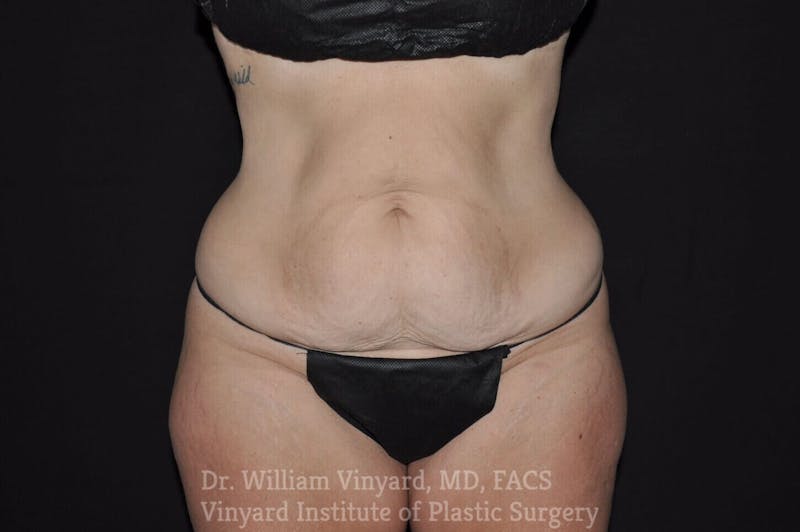 Tummy Tuck Before & After Gallery - Patient 169942797 - Image 1