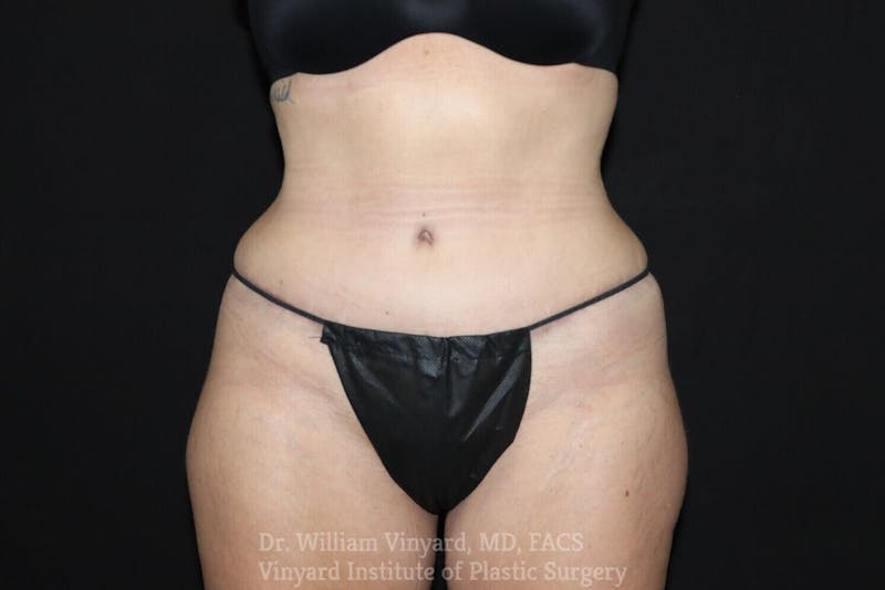 Tummy Tuck Before & After Gallery - Patient 169942797 - Image 2