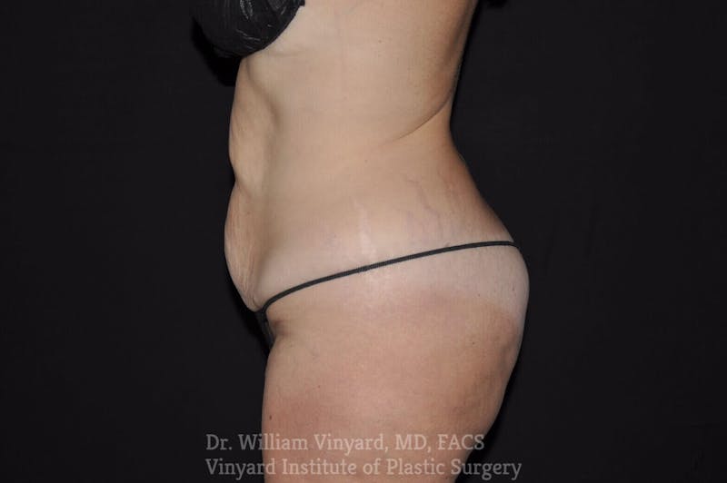 Tummy Tuck Before & After Gallery - Patient 169942797 - Image 3