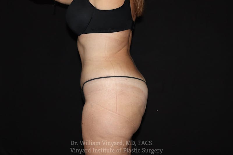 Tummy Tuck Before & After Gallery - Patient 169942797 - Image 4