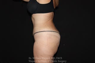 Tummy Tuck Before & After Gallery - Patient 169942797 - Image 4