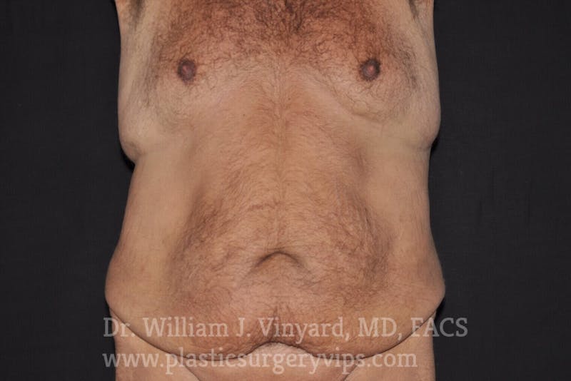 Tummy Tuck Before & After Gallery - Patient 169942798 - Image 1