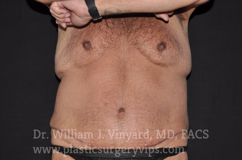 Tummy Tuck Before & After Gallery - Patient 169942798 - Image 2