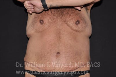 Tummy Tuck Before & After Gallery - Patient 169942798 - Image 2