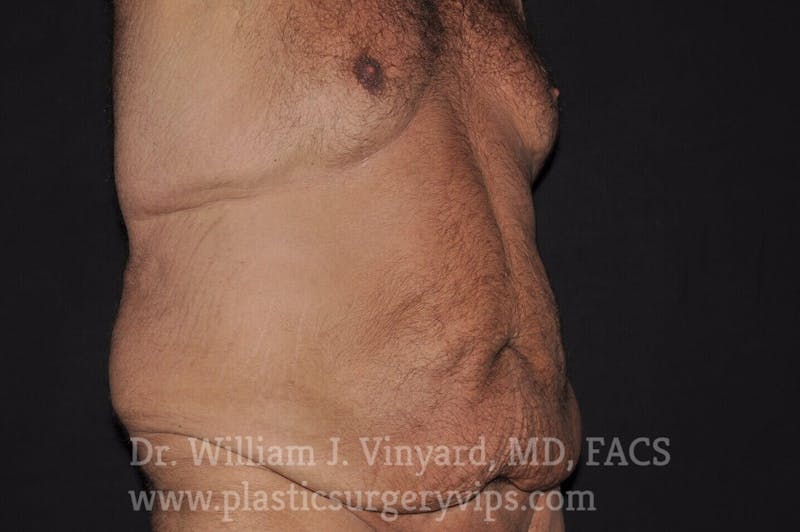 Tummy Tuck Before & After Gallery - Patient 169942798 - Image 3