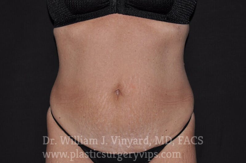 Tummy Tuck Before & After Gallery - Patient 169942800 - Image 1