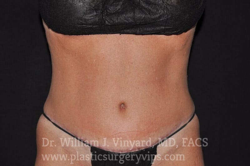 Tummy Tuck Before & After Gallery - Patient 169942800 - Image 2
