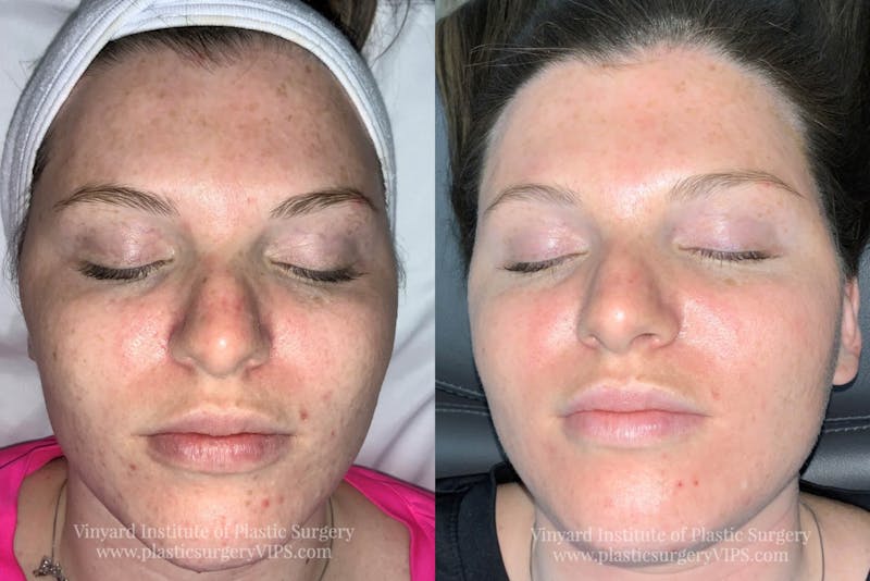 Chemical Peel Before & After Gallery - Patient 169943579 - Image 1