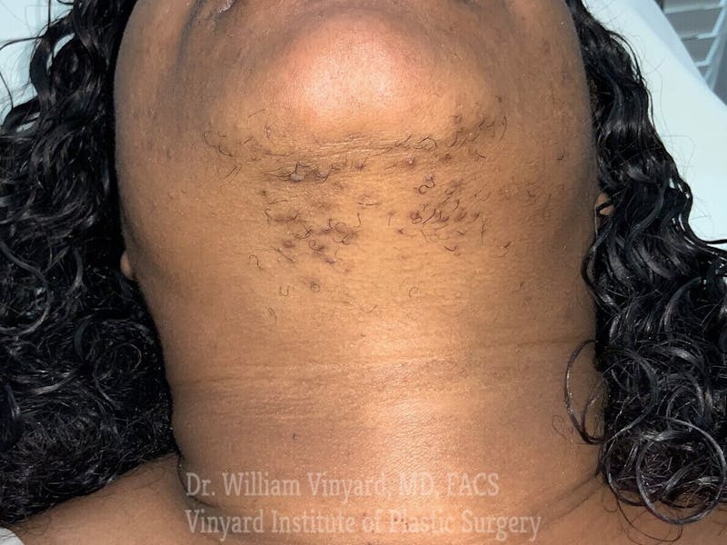 Laser Hair Removal Before & After Gallery - Patient 169943647 - Image 1