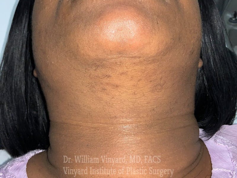 Laser Hair Removal Before & After Gallery - Patient 169943647 - Image 2