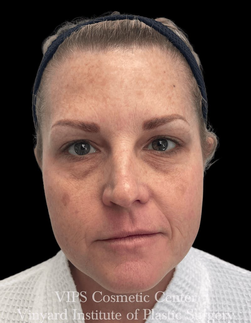Skin Pigment Removal Before & After Gallery - Patient 169943745 - Image 1