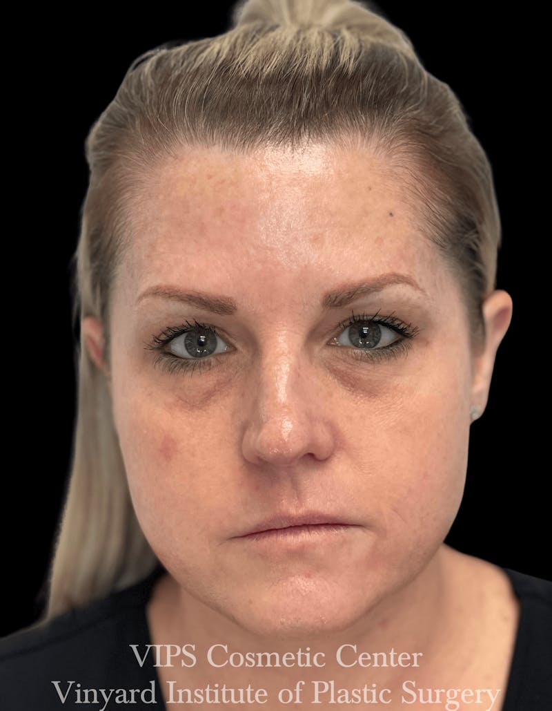 Skin Pigment Removal Before & After Gallery - Patient 169943745 - Image 2