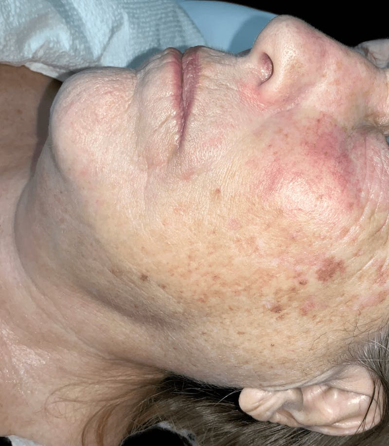 Skin Pigment Removal Before & After Gallery - Patient 169943773 - Image 1